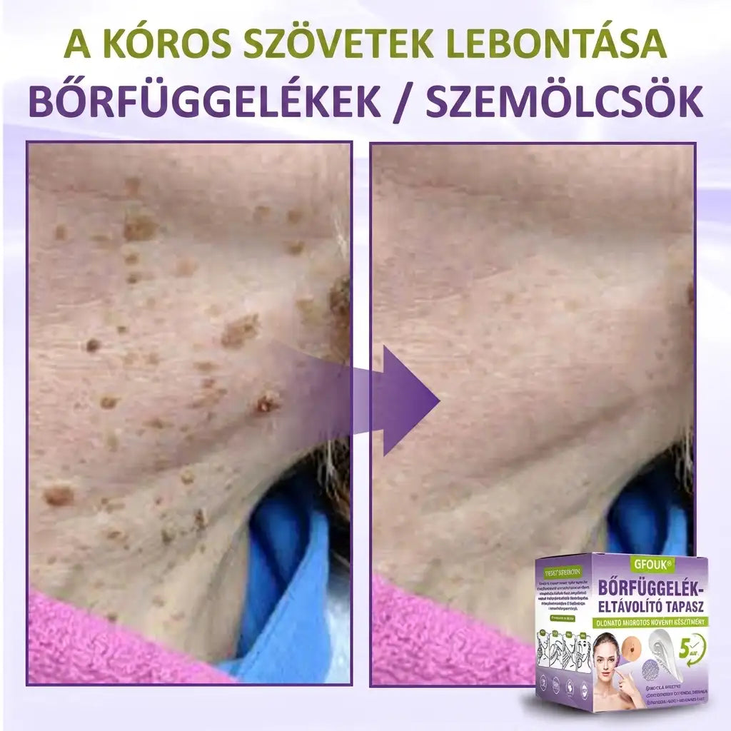 ✨GFOUK® oldódó mikrotűs növényi bőrfüggelék eltávolító tapasz🌴🌴
