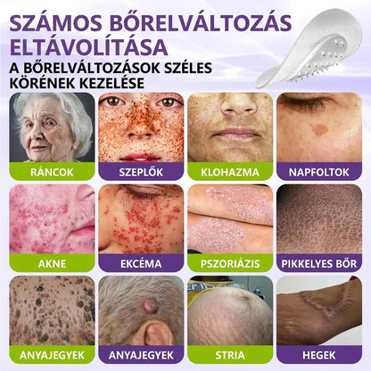 ✨GFOUK® oldódó mikrotűs növényi bőrfüggelék eltávolító tapasz🌴🌴