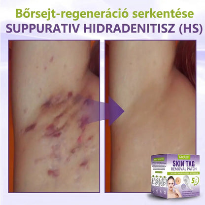 ✨GFOUK® oldódó mikrotűs növényi bőrfüggelék eltávolító tapasz🌴🌴