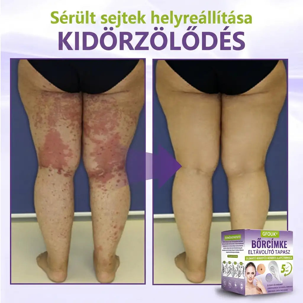 ✨GFOUK® oldódó mikrotűs növényi bőrfüggelék eltávolító tapasz🌴🌴
