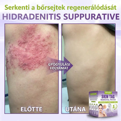 ✨GFOUK® oldódó mikrotűs növényi bőrfüggelék eltávolító tapasz🌴🌴