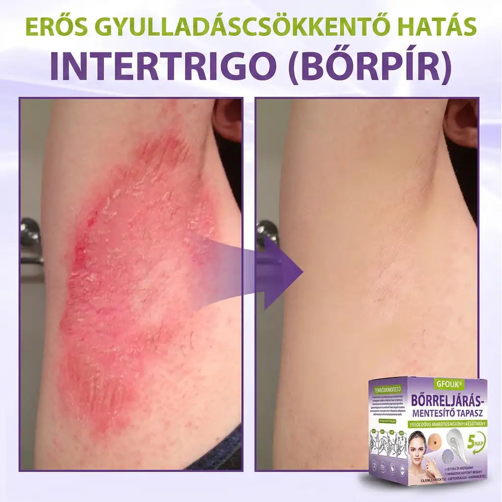 ✨GFOUK® oldódó mikrotűs növényi bőrfüggelék eltávolító tapasz🌴🌴
