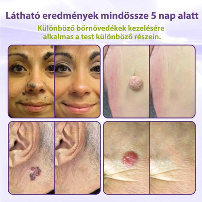 ✨GFOUK® oldódó mikrotűs növényi bőrfüggelék eltávolító tapasz🌴🌴
