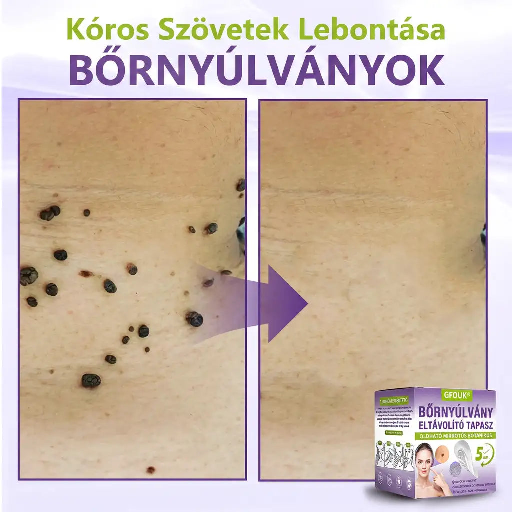 ✨GFOUK® oldódó mikrotűs növényi bőrfüggelék eltávolító tapasz🌴🌴