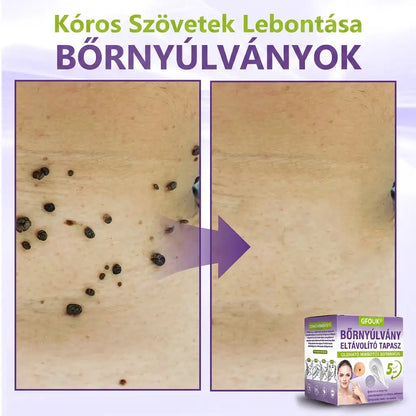 ✨GFOUK® oldódó mikrotűs növényi bőrfüggelék eltávolító tapasz🌴🌴